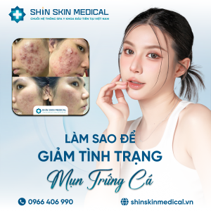 Làm Sao Để Giảm Tình Trạng Mụn Trứng Cá An Toàn, Hiệu Quả Chuẩn Y Khoa?