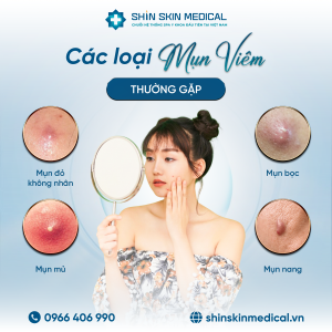 Phân Biệt Các Loại Mụn Viêm Thường Gặp: Nhận Diện Đúng Để Xử Lý Chuẩn Y Khoa