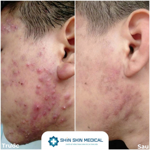 Gói Chăm Sóc Da Mụn - Ba Cấp Độ