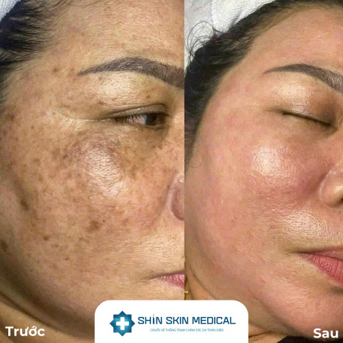Gói Chăm Sóc Da Nám - Ba Cấp Độ